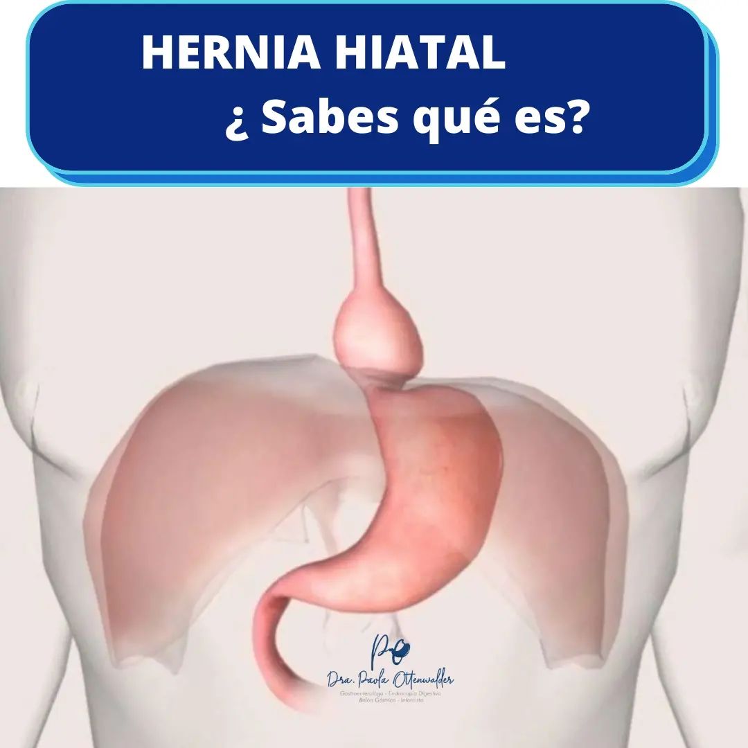 hernia hiatal