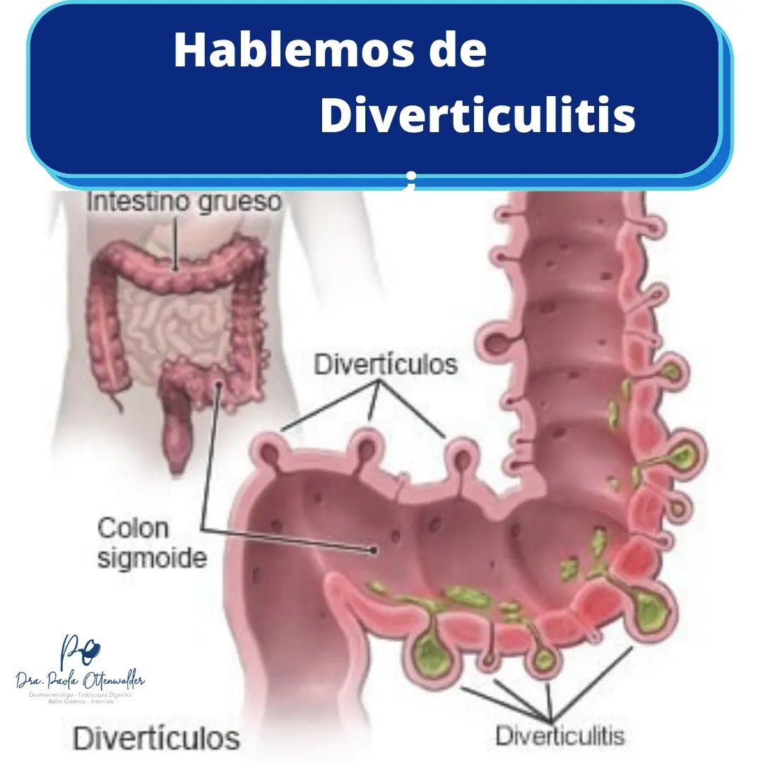 diverticulitis